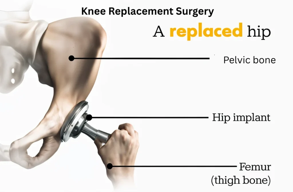 Best Knee Replacement Hospital in Chennai