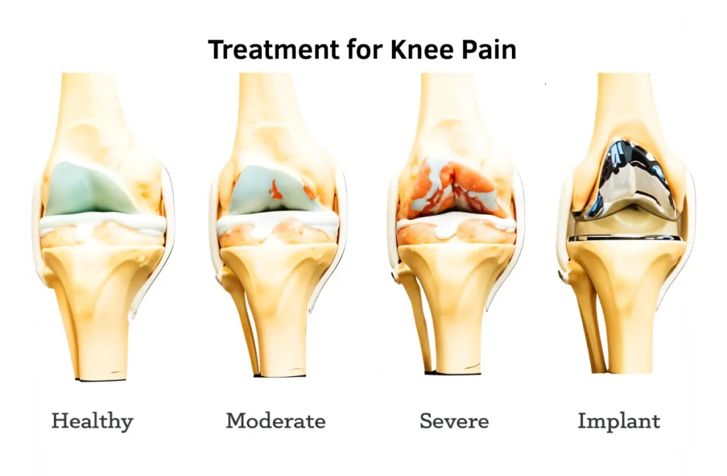 Best Treatment for Knee Pain