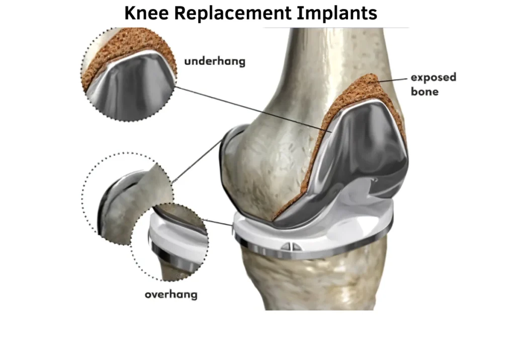 Knee Replacement Implants 1 Knee Replacement Implants