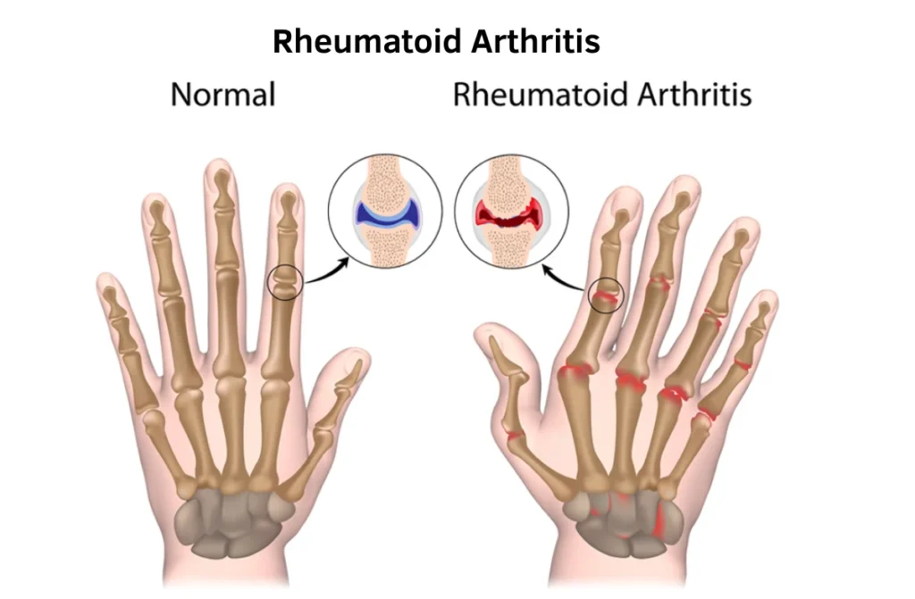 Early Signs of Rheumatoid Arthritis