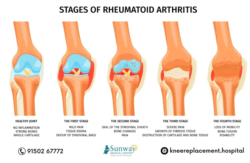 Rheumatoid Arthritis Specialist in Chennai 1 Rheumatoid Arthritis Specialist in Chennai