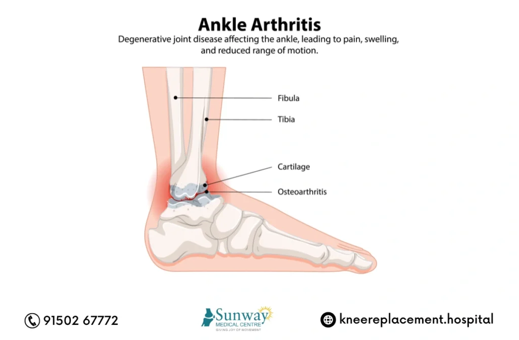 Ankle Arthroscopy in Chennai 2 Ankle Arthroscopy in Chennai